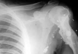 An X-Ray of the Jim's shattered arm.