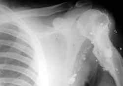 An X-Ray of the Jim's shattered arm.